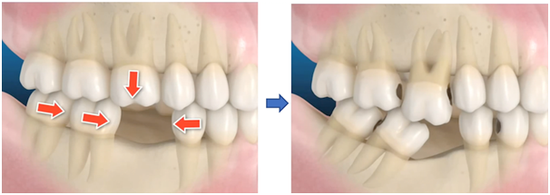 missing teeth replace tooth consequences fix